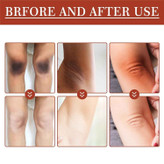 روغن لایهبردار از بین برنده تیرگی پوست آکانتوز نیگریکانس Acanthosis Nigricans