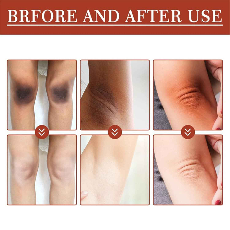 روغن لایهبردار از بین برنده تیرگی پوست آکانتوز نیگریکانس Acanthosis Nigricans