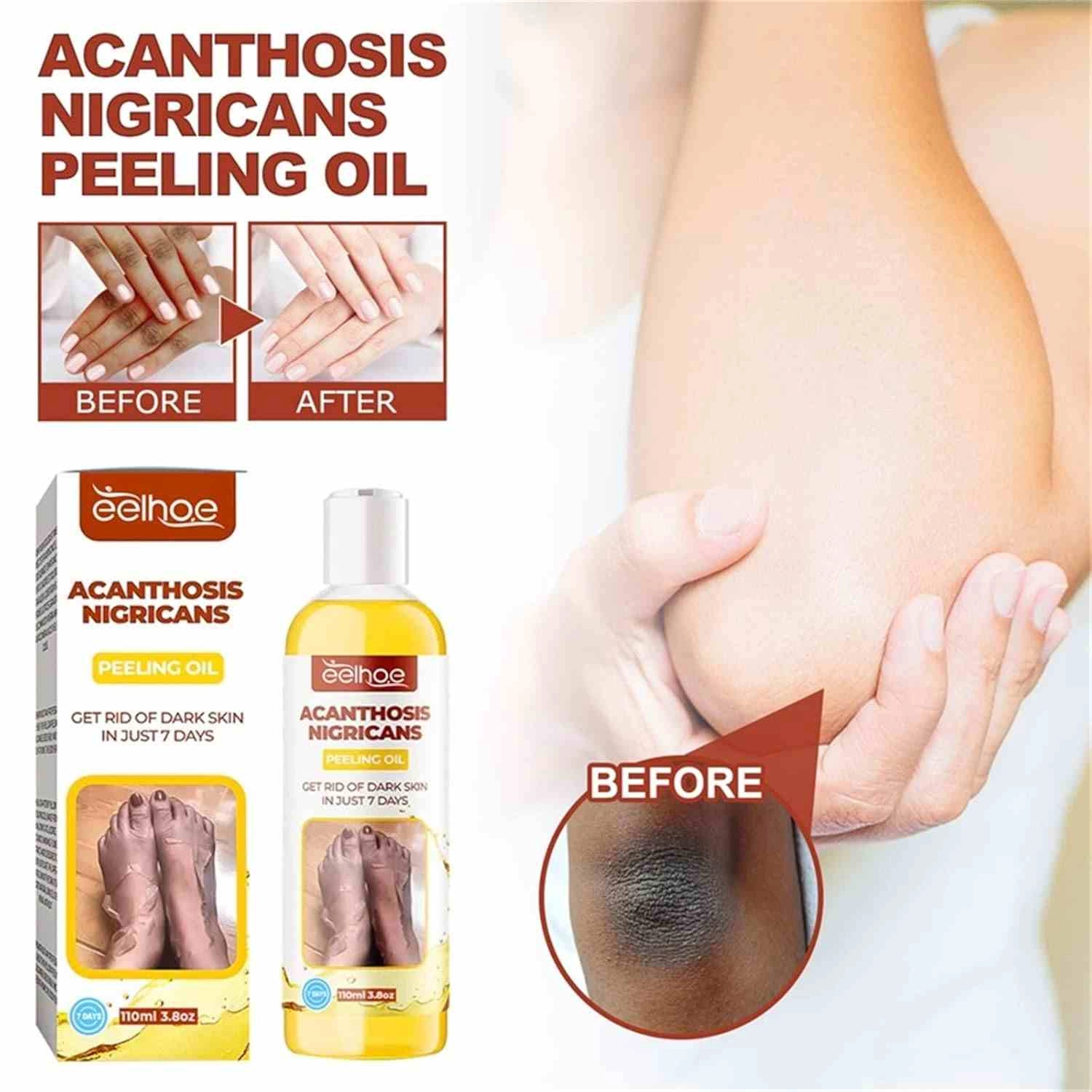 روغن لایه‌بردار از بین برنده تیرگی پوست  آکانتوز نیگریکانس Acanthosis Nigricans