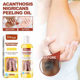 روغن لایهبردار از بین برنده تیرگی پوست آکانتوز نیگریکانس Acanthosis Nigricans