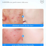 پک پچ ضد جوش و آکنه سادور مدل کاور کننده و ترمیم کننده 36 عددی